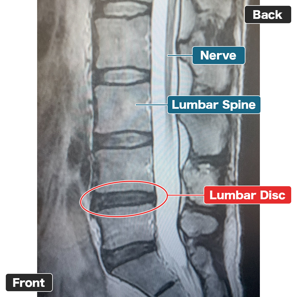 MRI