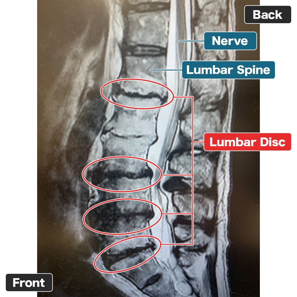 MRI