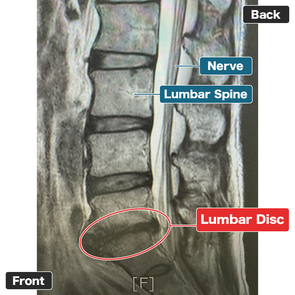 MRI