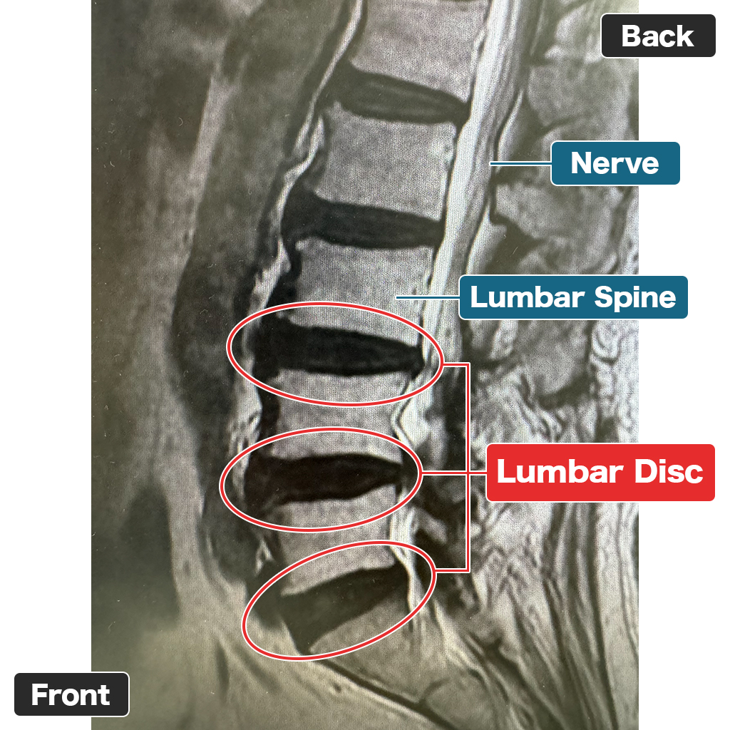 MRI