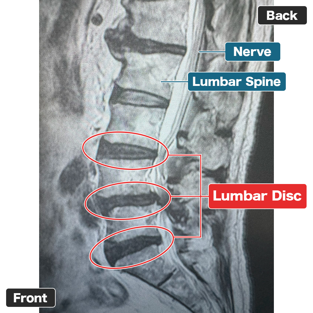 MRI