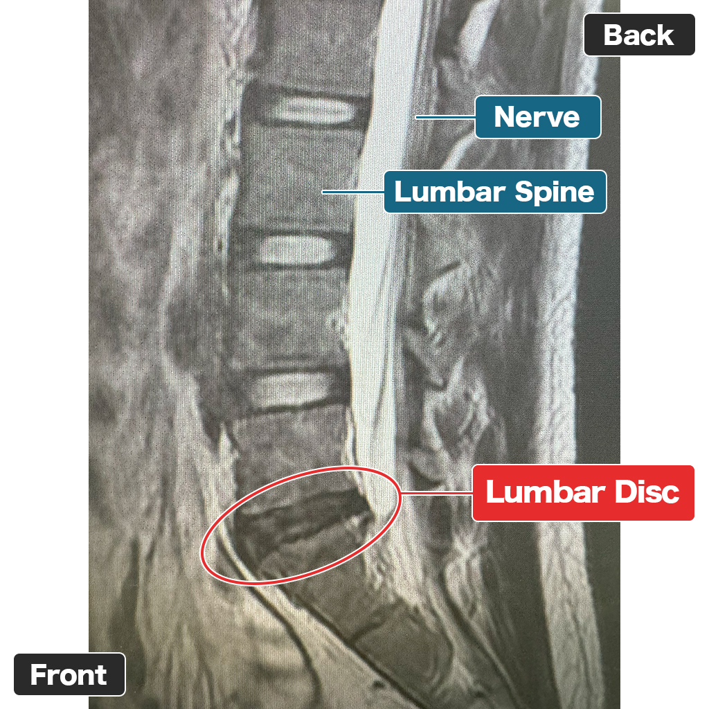 MRI