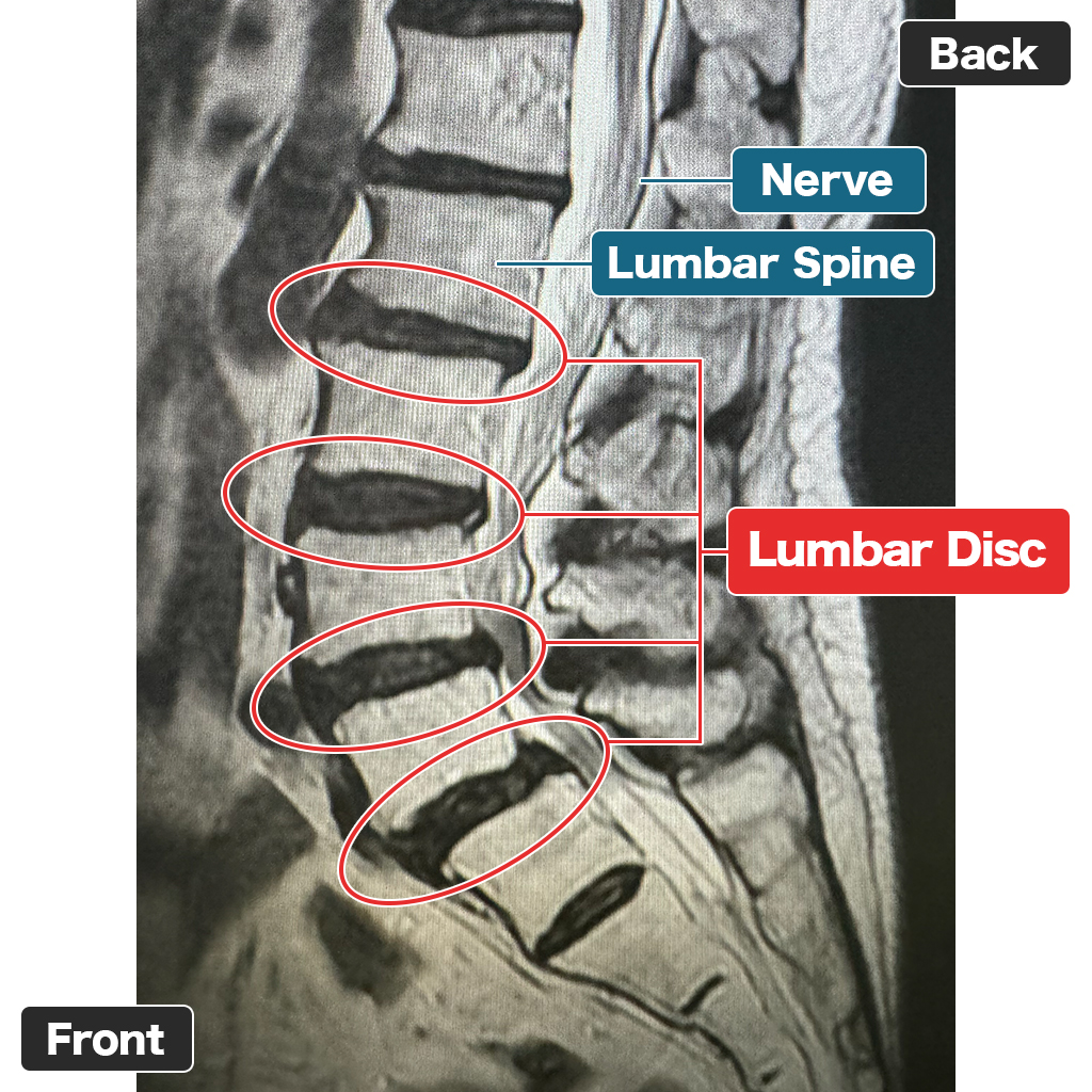 MRI