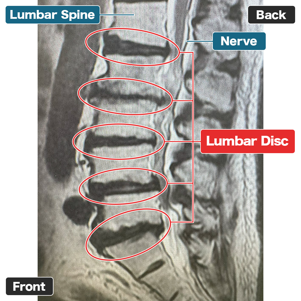 MRI