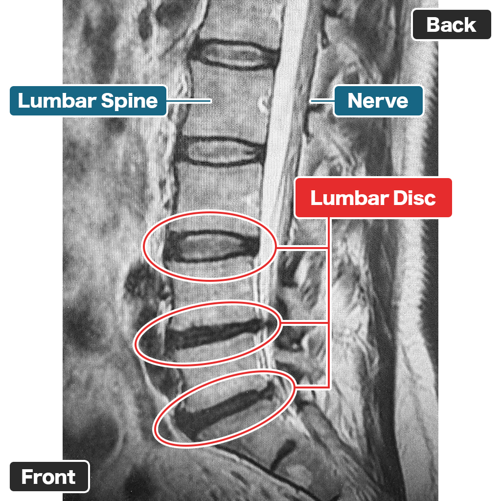 MRI