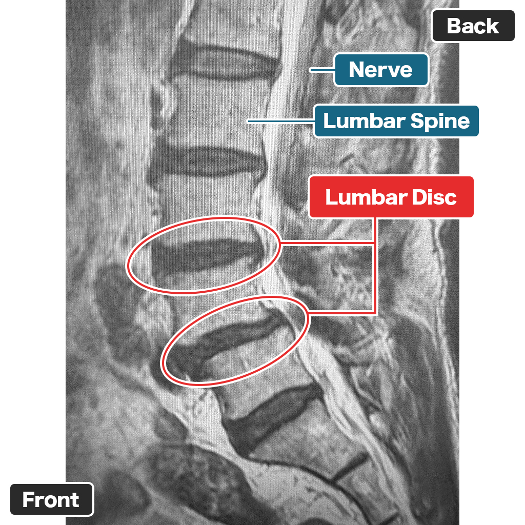 MRI