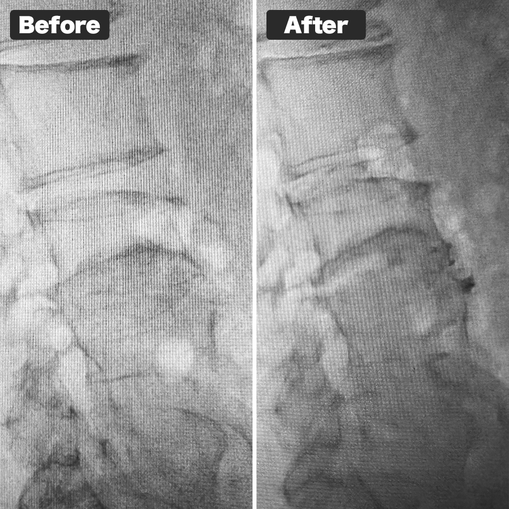 X-ray Photos Before and After Treatment
