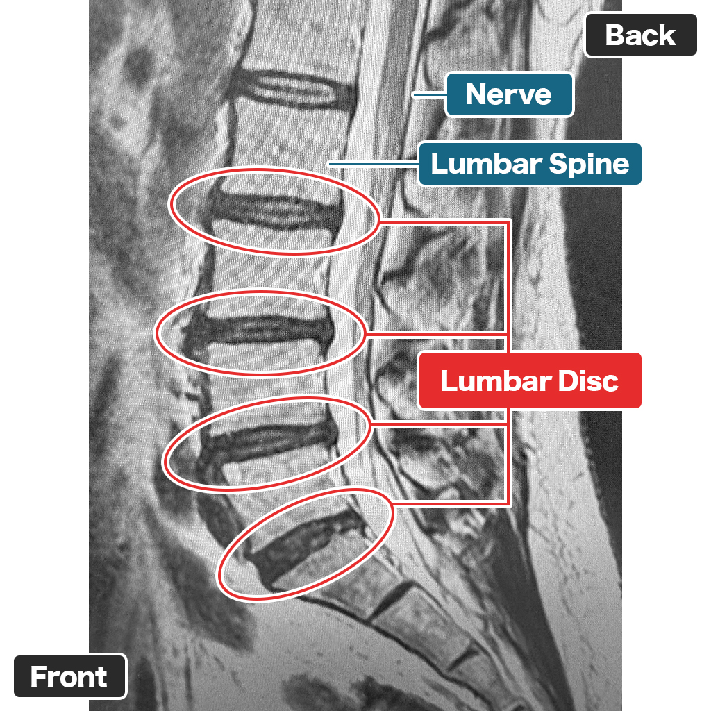 MRI