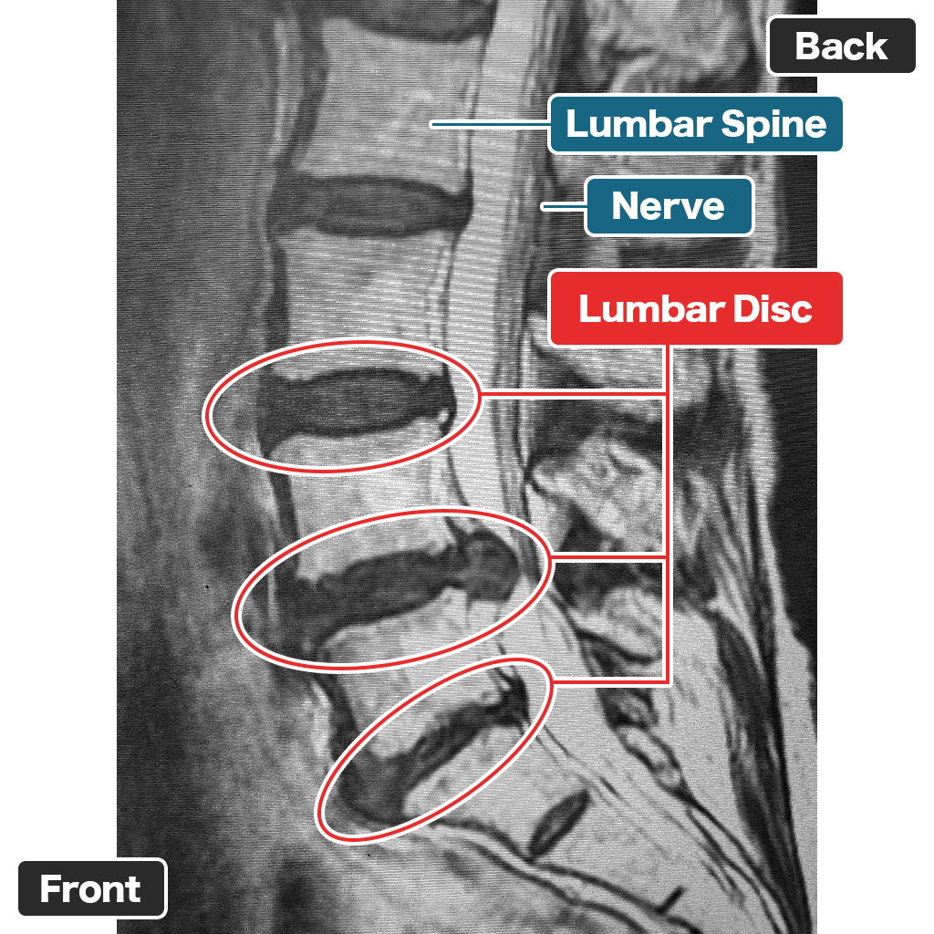 MRI