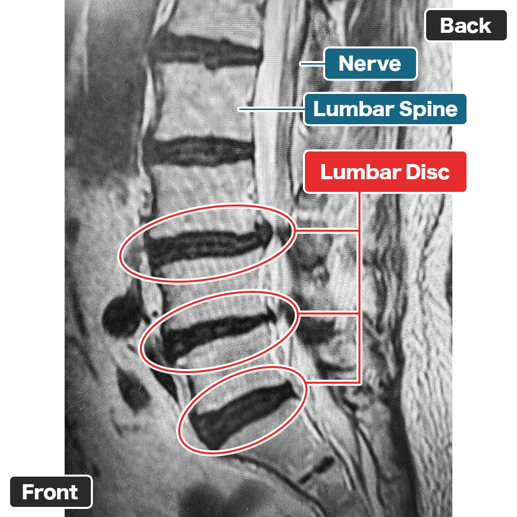 MRI
